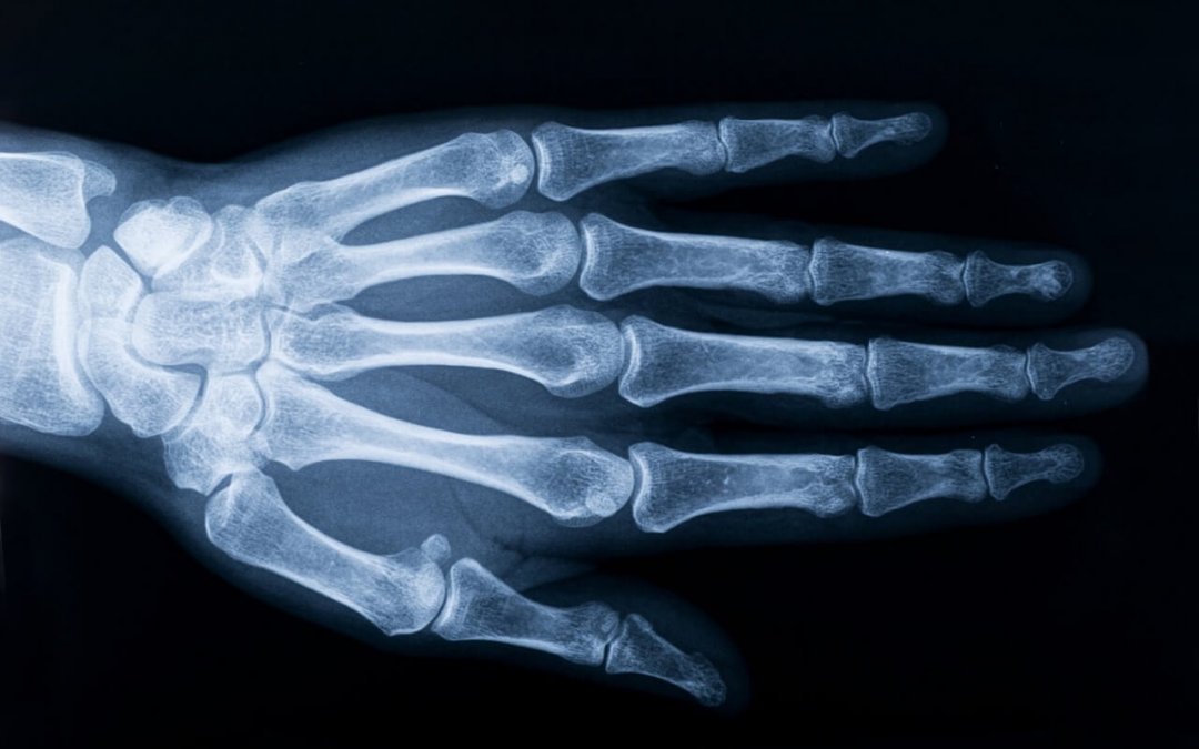 Osteoartrite como uma doença inflamatória (osteoartrite não é osteoastrose!)