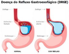 refluxo