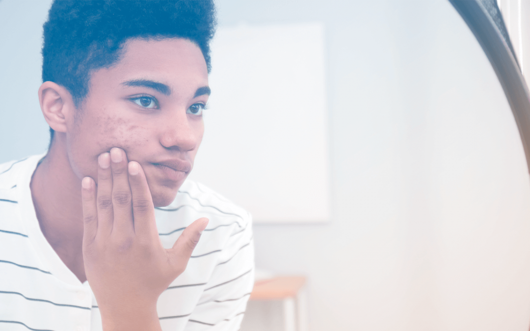 Saiba mais sobre o uso de probióticos para a pele acneica