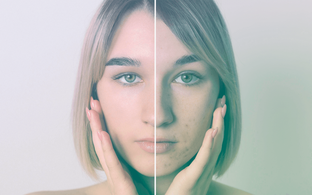 Proderma lança linha antiacne exclusiva