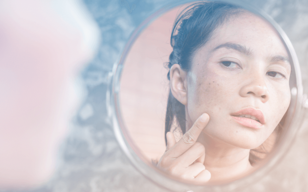 Saiba tudo sobre o Melasma